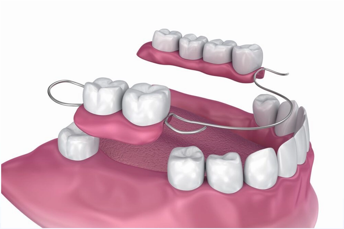 Dentures at Gateway Dental