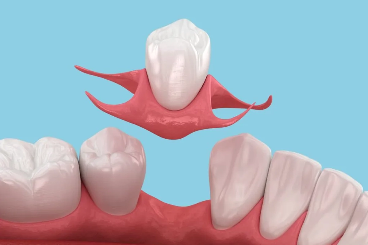 Dentures at Gateway Dental