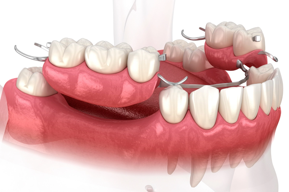 Dentures at Gateway Dental
