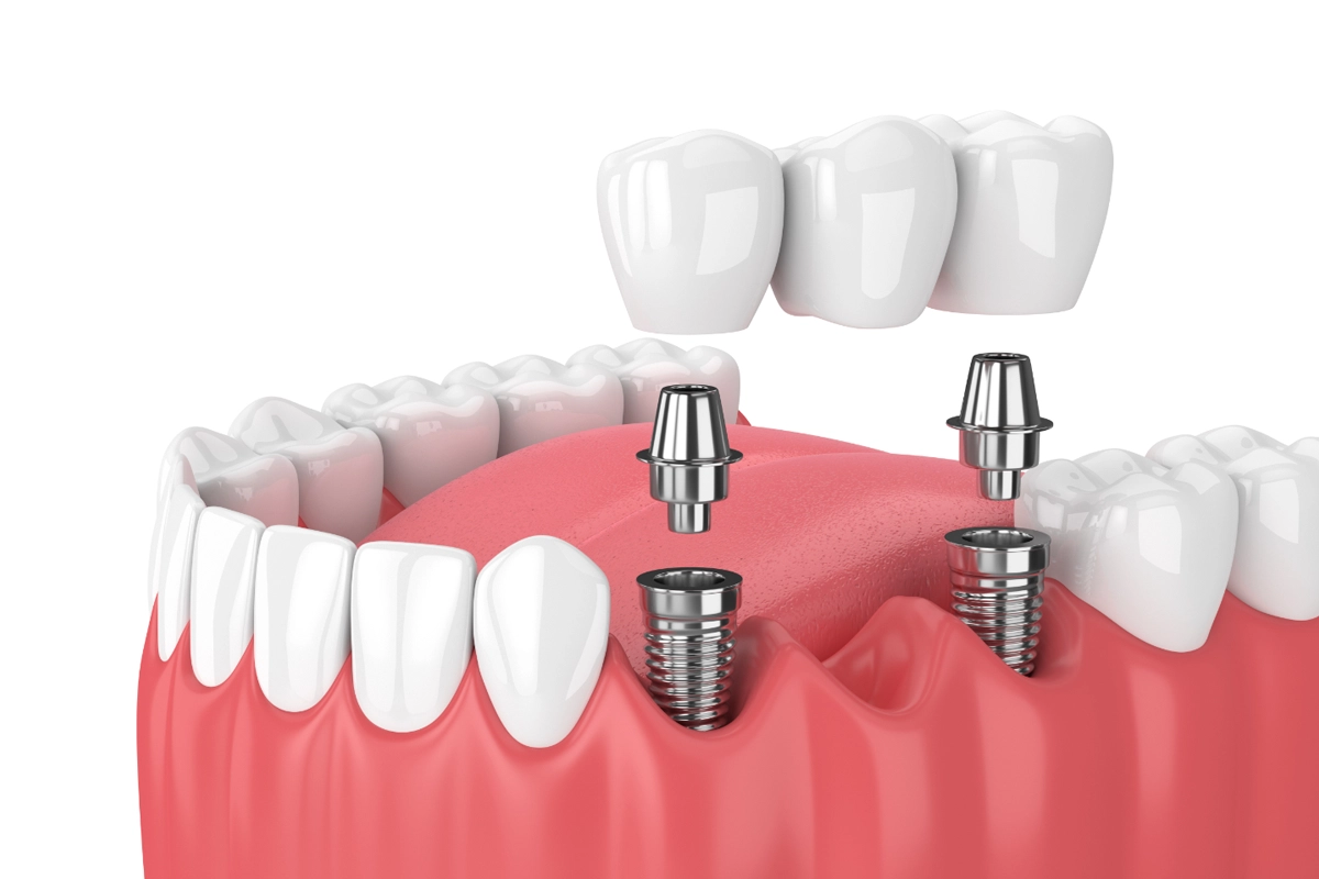 Dental Implants at Gateway Dental