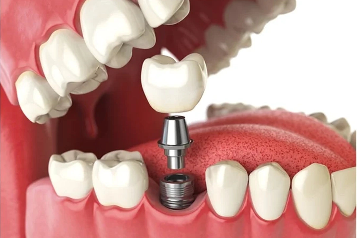 Dental Implants at Gateway Dental