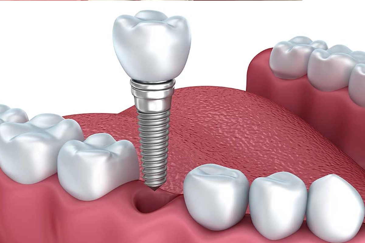Dental Implants at Gateway Dental