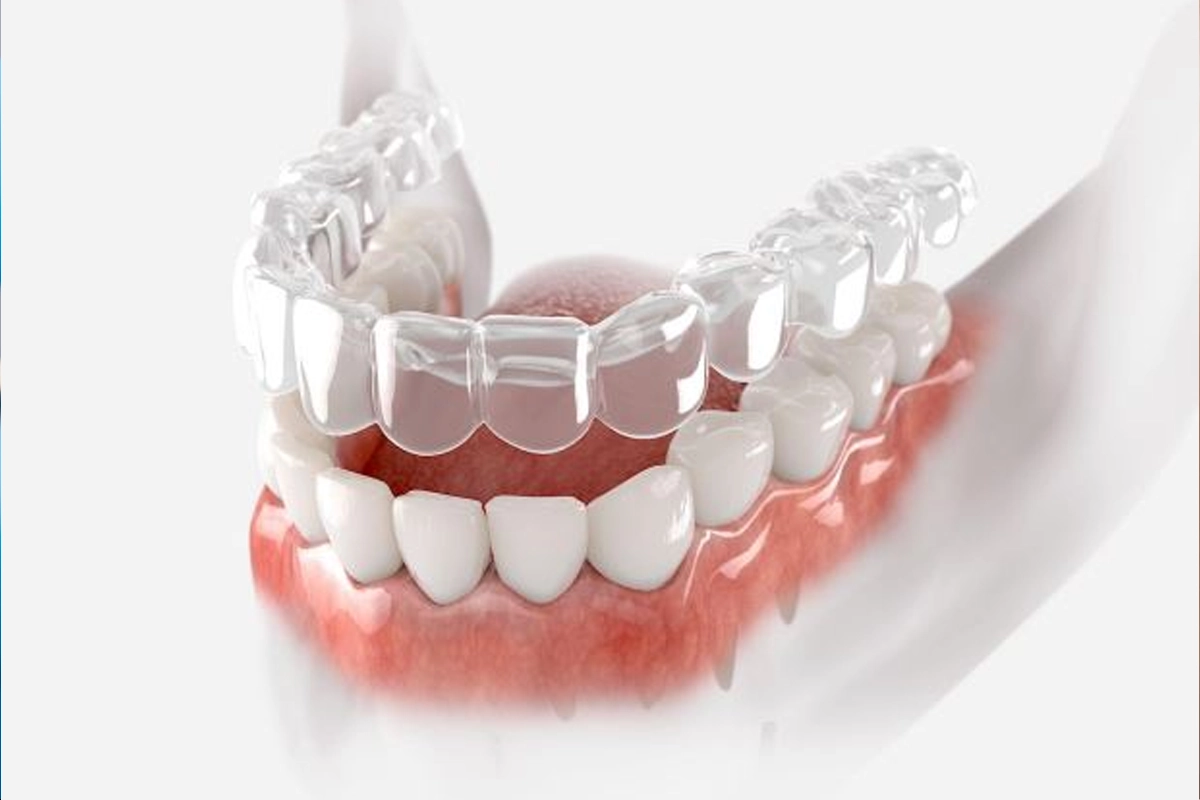 Invisalign at Gateway Dental