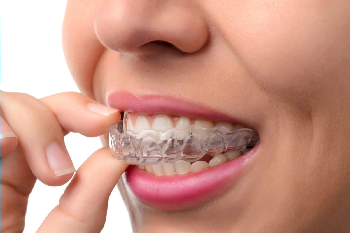 Invisalign at Gateway Dental