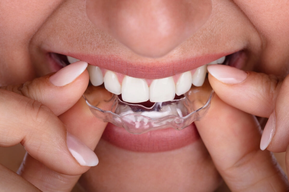 Invisalign at Gateway Dental