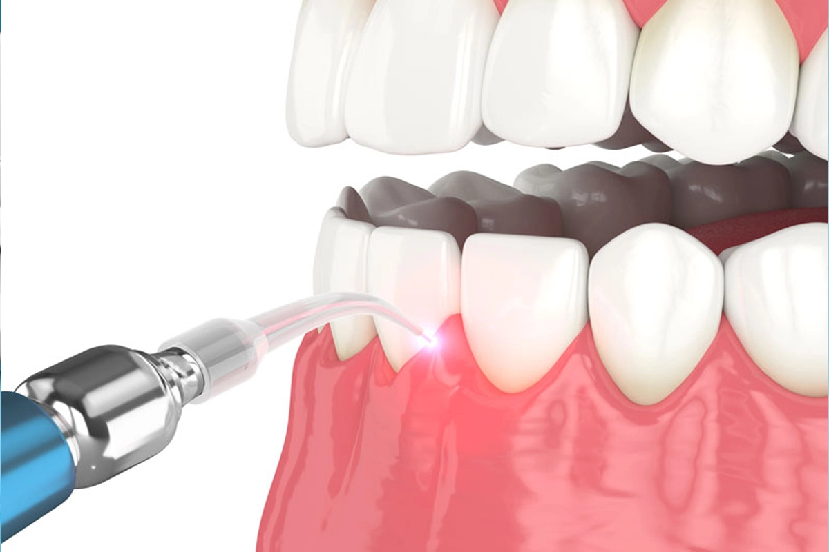 Laser Gum Treatment at Gateway Dental