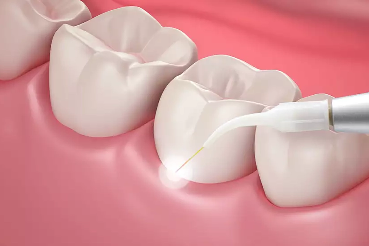 Laser Gum Treatment at Gateway Dental