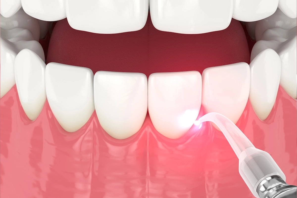 Laser Gum Treatment at Gateway Dental