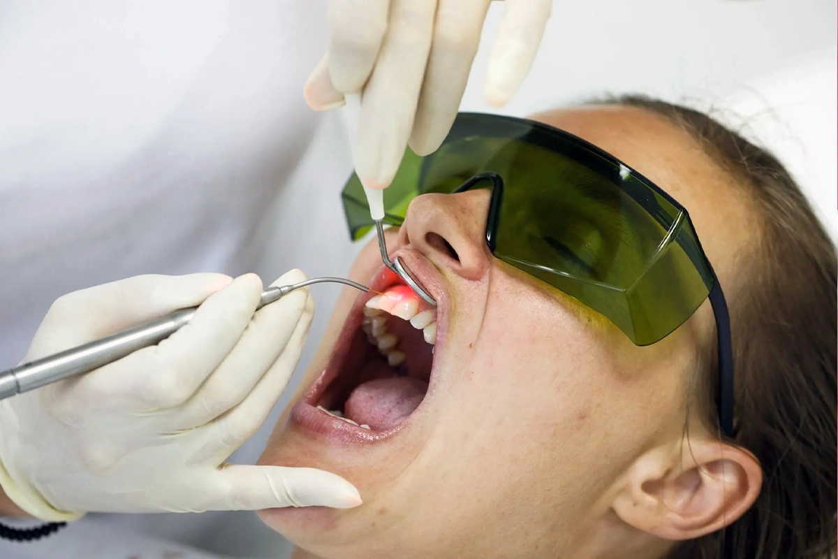 Laser Gum Treatment at Gateway Dental