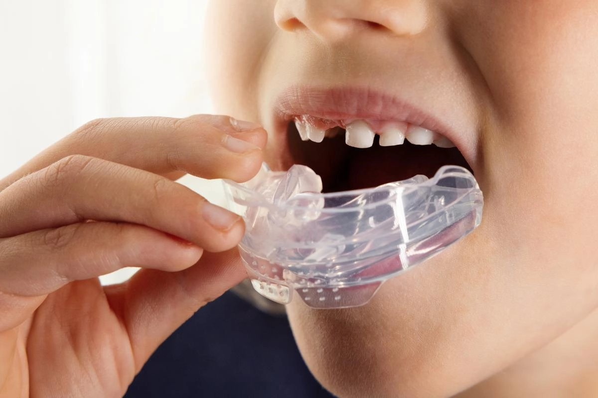 Custom Mouth Guards at Gateway Dental