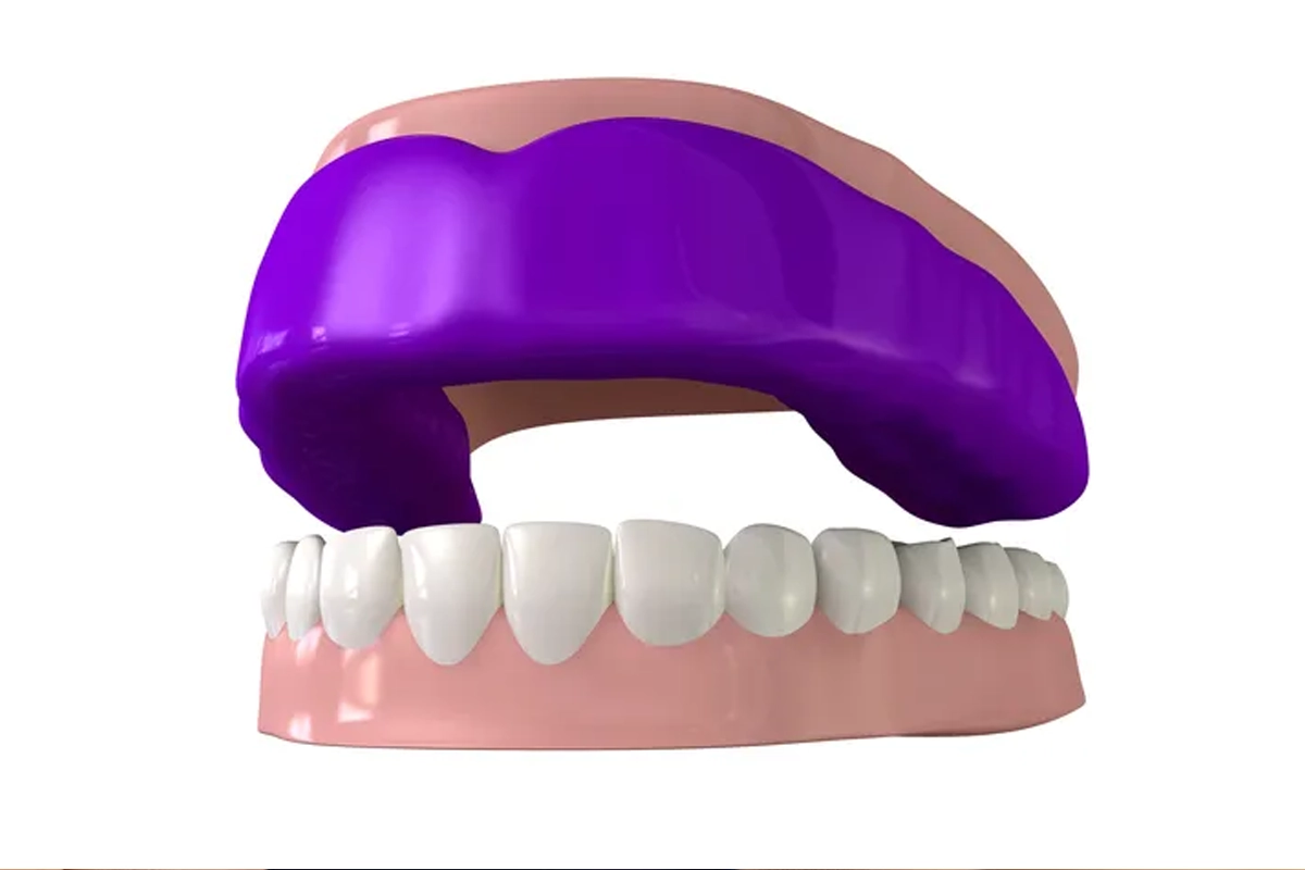 Custom Mouth Guards at Gateway Dental