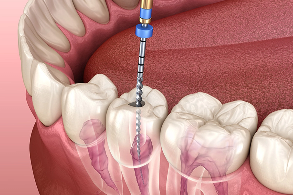 Root Canal at Gateway Dental