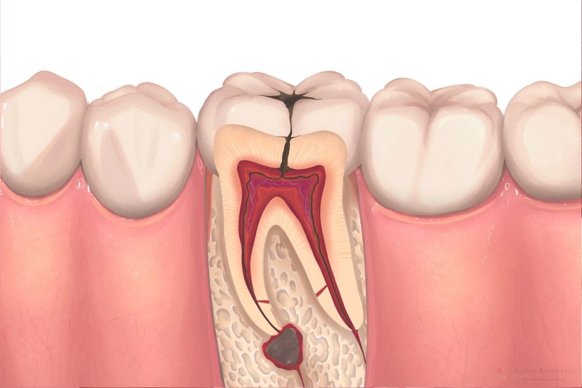 Root Canal at Gateway Dental