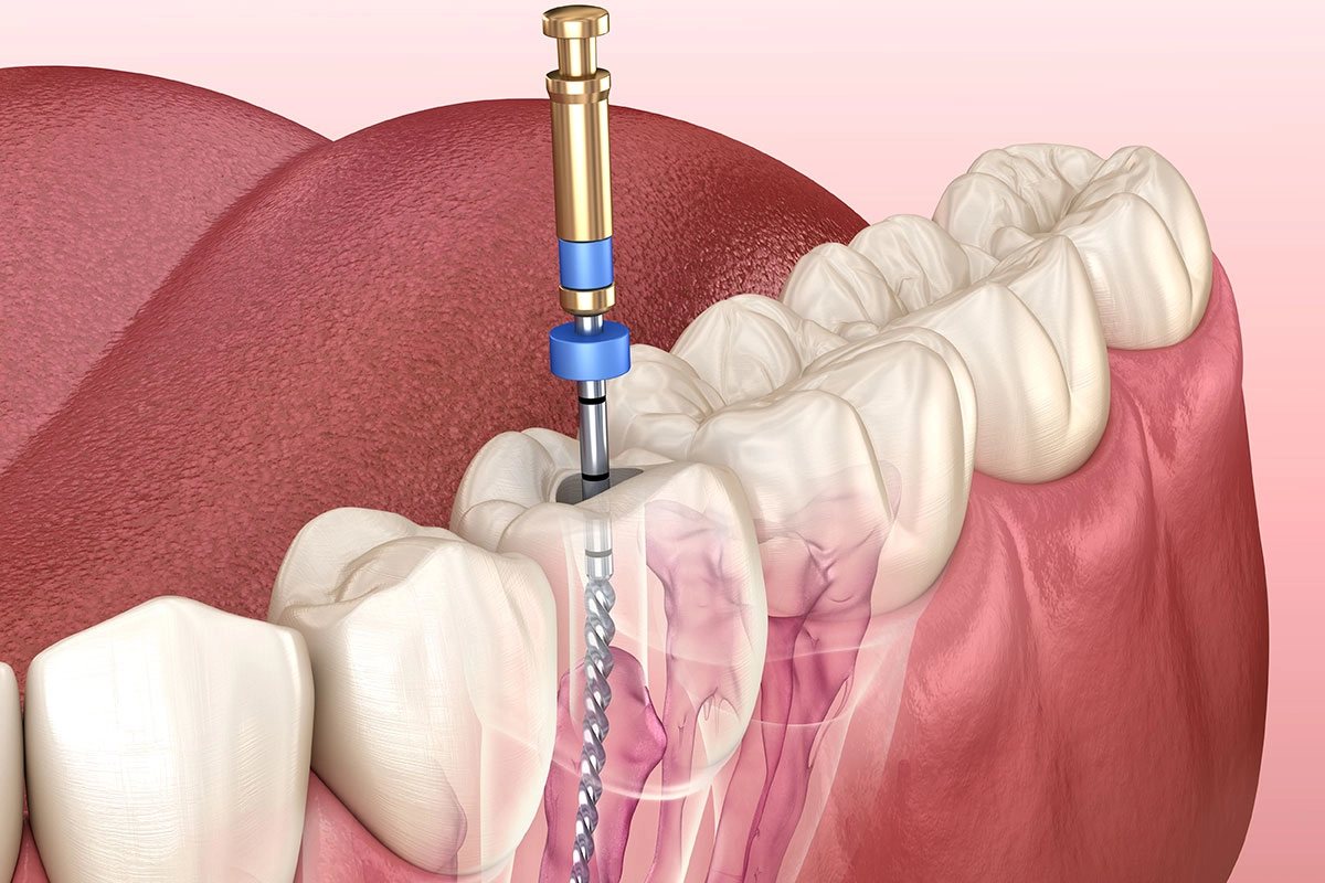 Root Canal at Gateway Dental